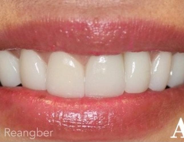 Cosmetic Implant Crowns and Traditional Crowns after