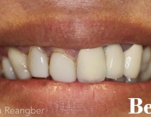 Cosmetic Implant Crowns and Traditional Crowns before