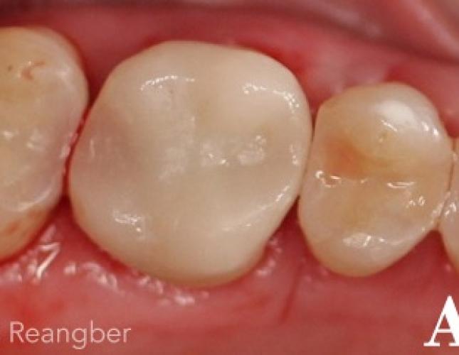 Crown and Fillings after