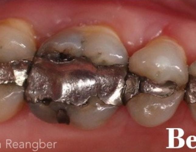 Crown and Fillings before