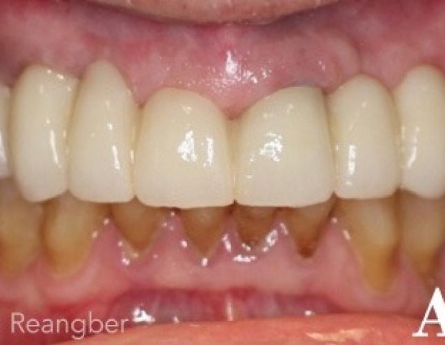 Fixed Implant Supported Bridge after