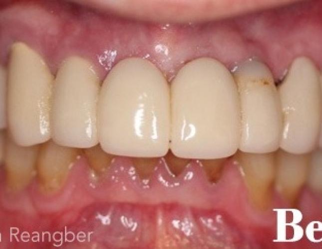 Fixed Implant Supported Bridge before