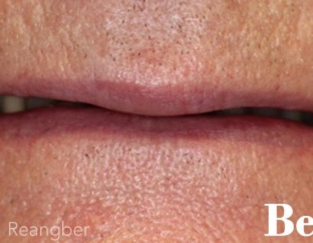 Implant Supported Crowns and Bridges before