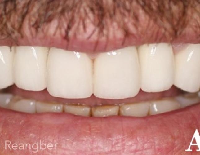 Implant and Porcelain Crowns after