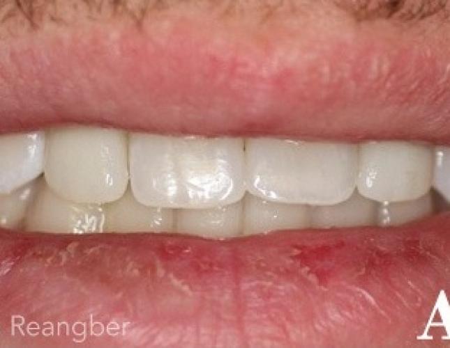 Implant Crowns for Missing Lateral Teeth after