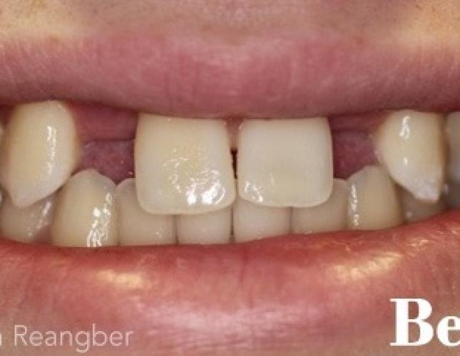 Implant Crowns for Missing Lateral Teeth before