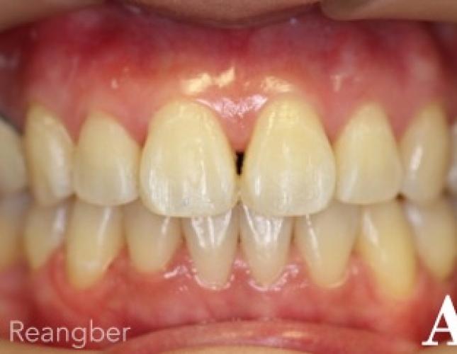 Invisalign after