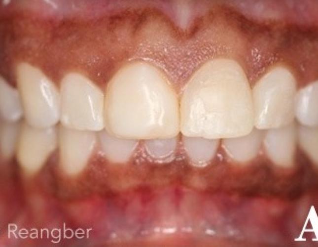 Invisalign 10 after
