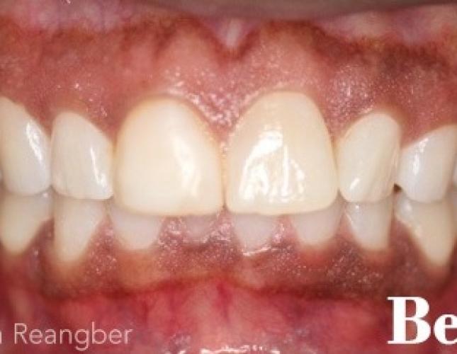 Invisalign 10 before