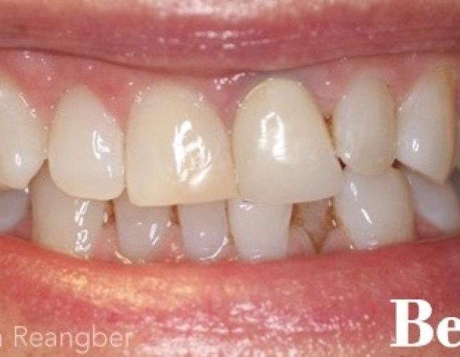 Invisalign 11 before