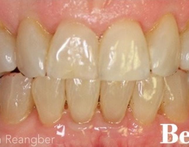 Invisalign 12 before