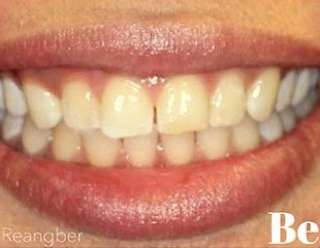 Invisalign 13 before