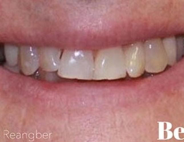 Invisalign 14 before