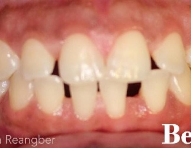Invisalign 3 before