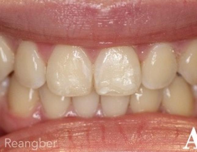 Invisalign 5 after
