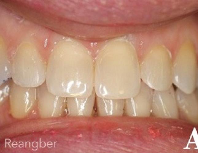 Invisalign 6 after