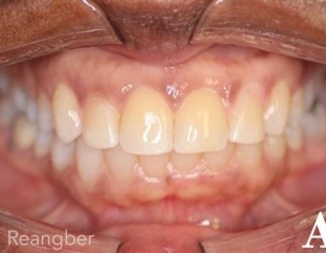 Invisalign 7 after