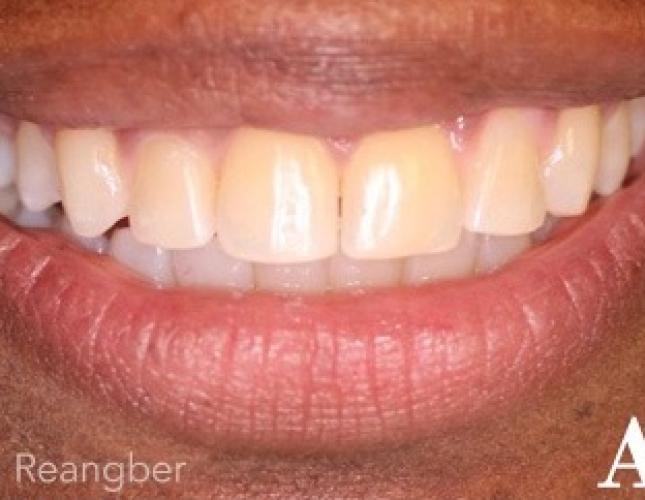 Invisalign 8 after