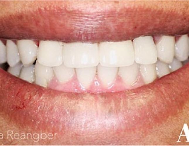 Porcelain Bridges and Crowns 2 after