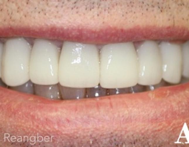 Porcelain Bridges and Crowns 1 after