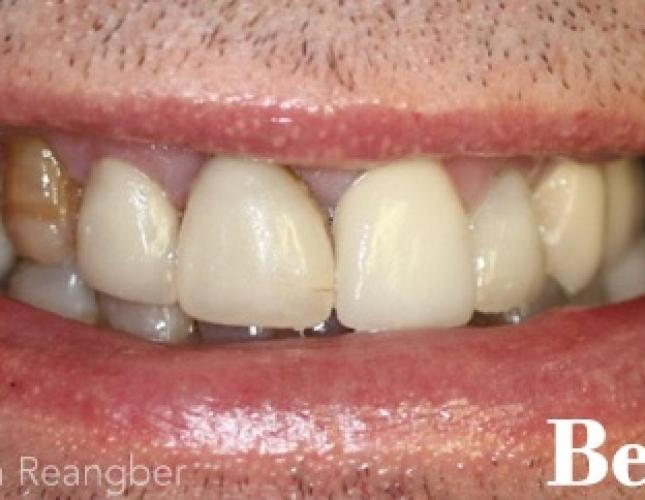 Porcelain Bridges and Crowns 1 before