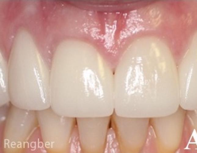 Porcelain Crowns 1 After