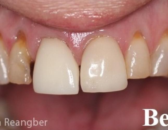 Porcelain Crowns 1 Before