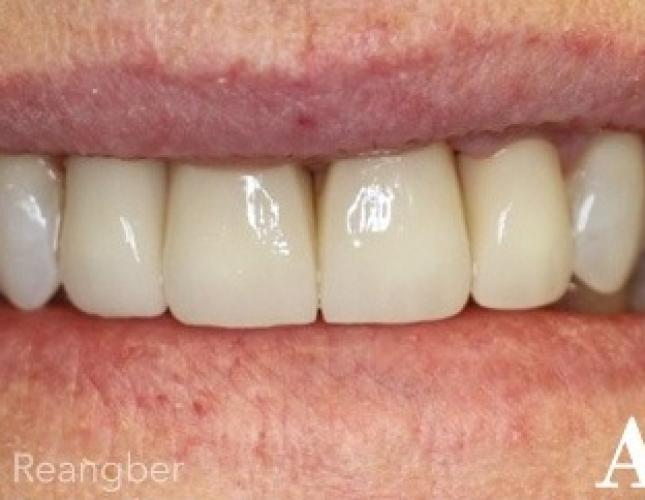 Porcelain Crowns 10 after