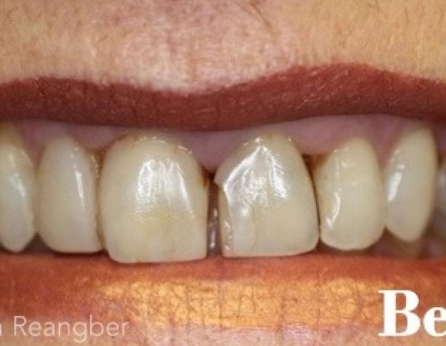 Porcelain Crowns 10 before