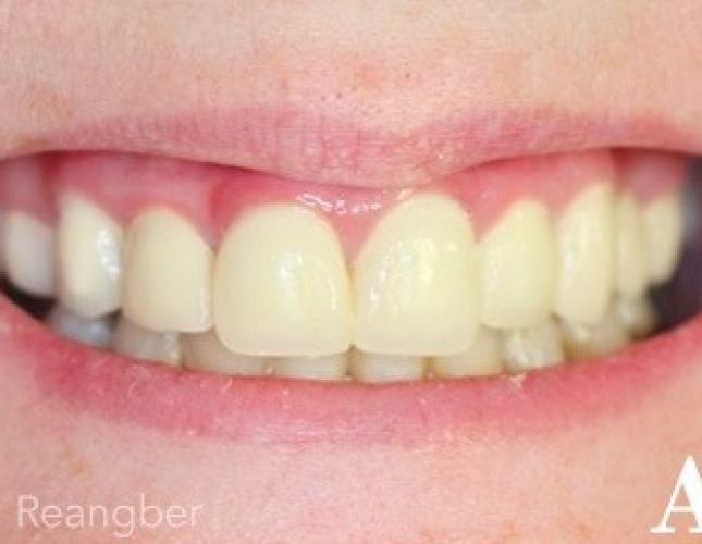 Porcelain Crowns 11 after