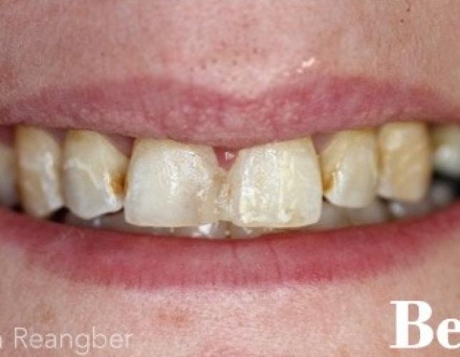 Porcelain Crowns 11 before