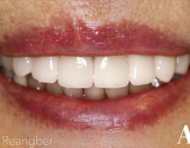 Porcelain Crowns 12 after