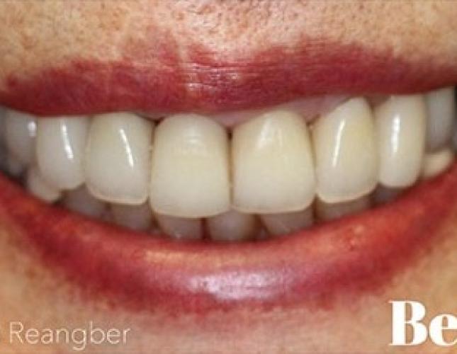 Porcelain Crowns 12 before