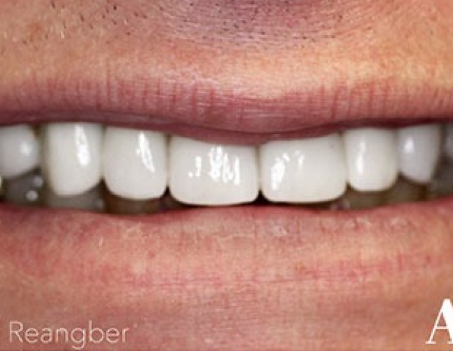 Porcelain Crowns 13 after