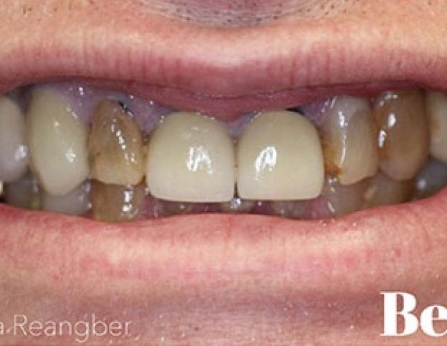 Porcelain Crowns 13 before