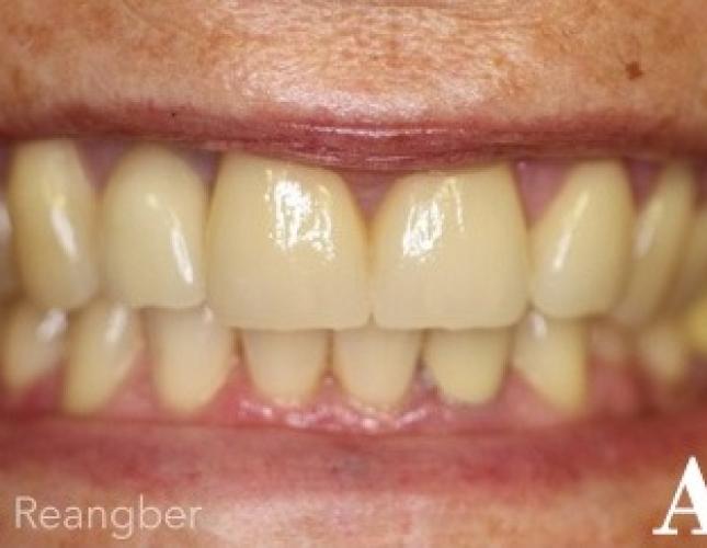 Porcelain Crowns 2 after