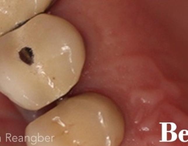 Porcelain Crowns 3 before