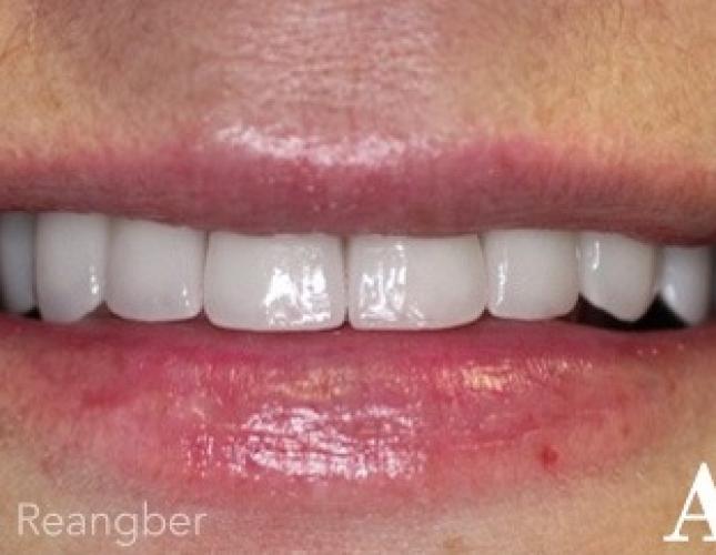 Porcelain Crowns 4 after