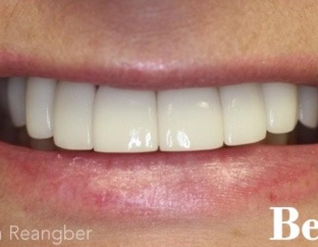 Porcelain Crowns 4 after