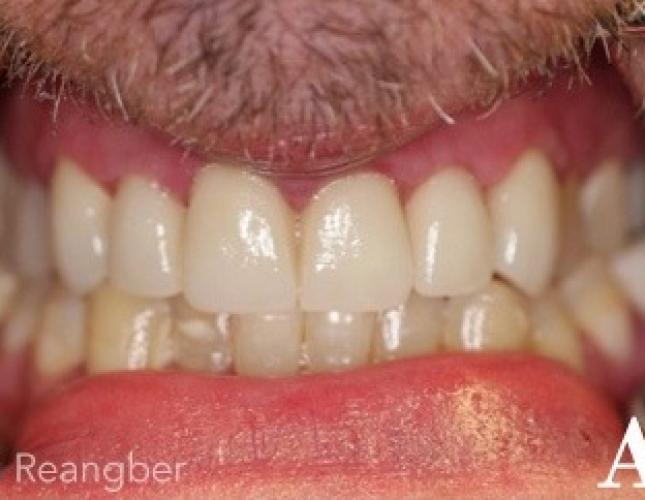 Porcelain Crowns 5 after