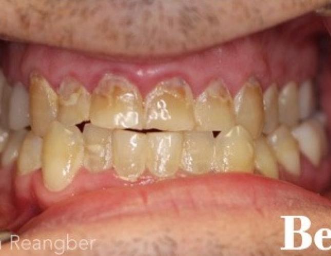 Porcelain Crowns 5 before