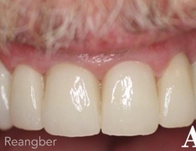 Porcelain Crowns 6 after