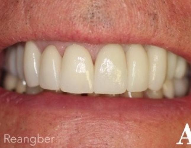 Porcelain Crowns 7 after