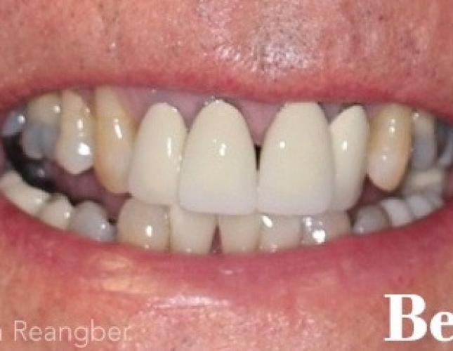 Porcelain Crowns 7 before