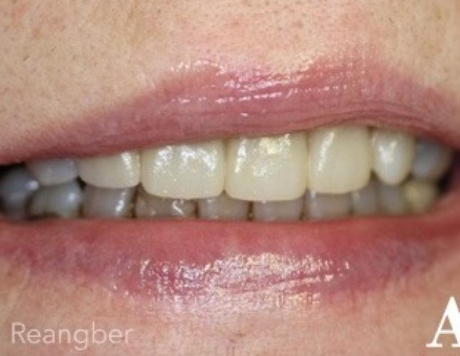 Porcelain Crowns 8 after