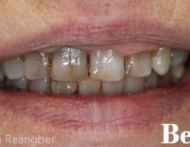 Porcelain Crowns 8 before