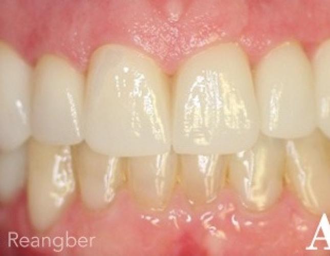 Porcelain Crowns 9 after