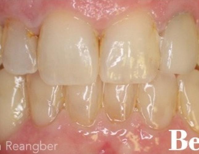 Porcelain Crowns 9 after