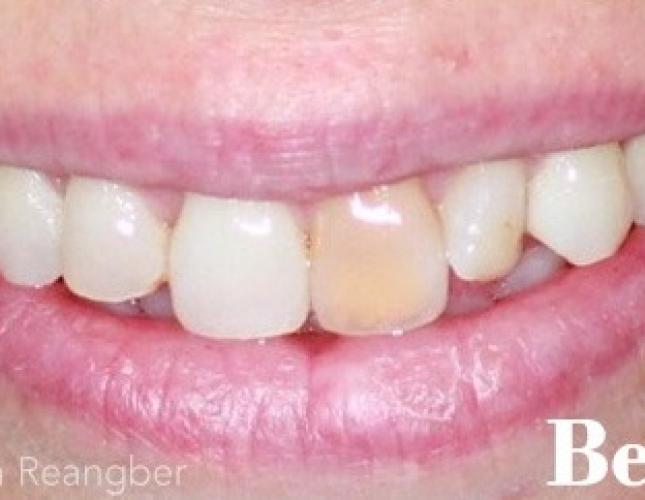 Porcelain Crowns and Veneers 1 before
