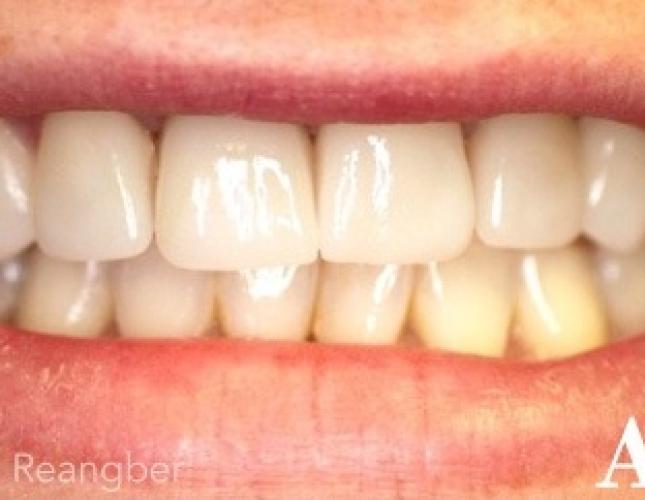 Porcelain Crowns and Veneers 2 after
